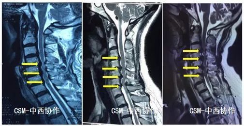 脊髓型颈椎病患者除了常规应避免长期低头,颈部保暖等日常保健外