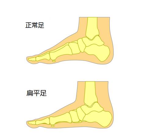 扁平足人士可穿矫正鞋垫不适合穿高跟鞋