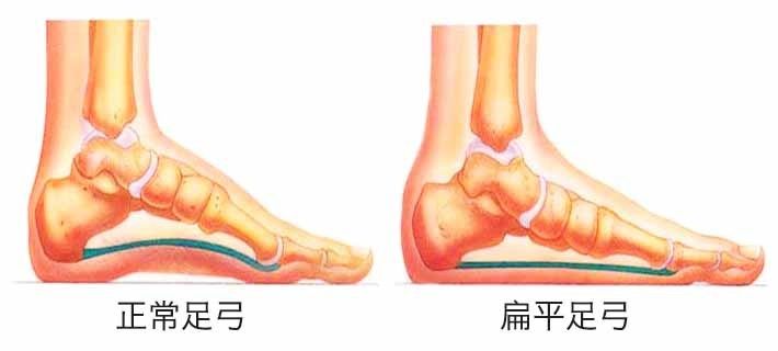 孩子走路容易脚疼可能是扁平足矫正鞋可干预