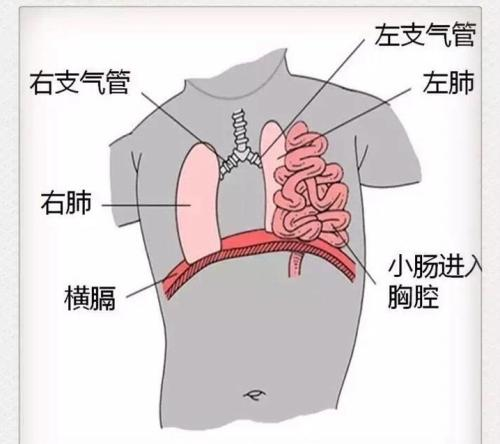 能治好胎儿膈疝千万别轻易放弃