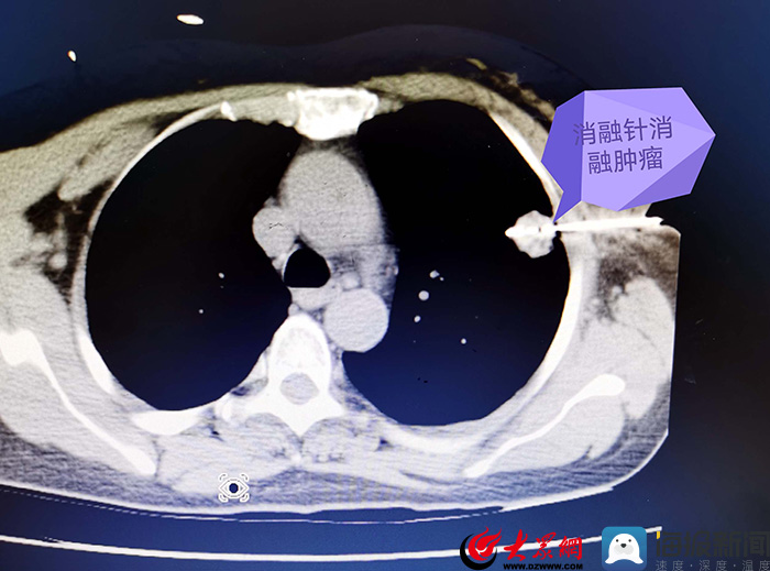 泰安市第一人民医院完成一例ct引导下危险部位肺肿瘤微波消融治疗
