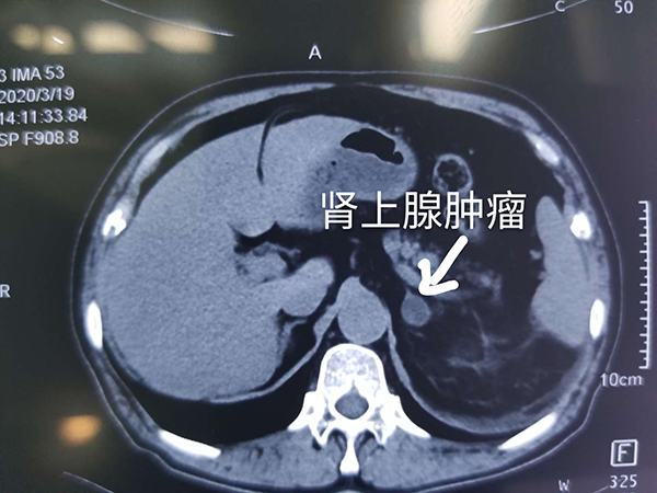 潍坊市中医院经典医案:八年"抗压" 元凶竟是肾上腺