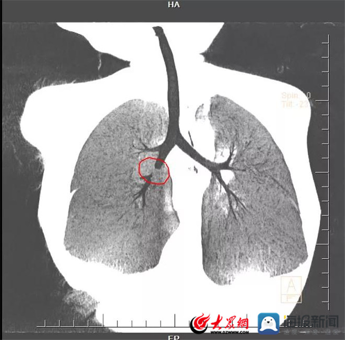 2岁男孩连喘3天,泰安市妇幼保健院采用电子支气管镜揪出"元凶"——半