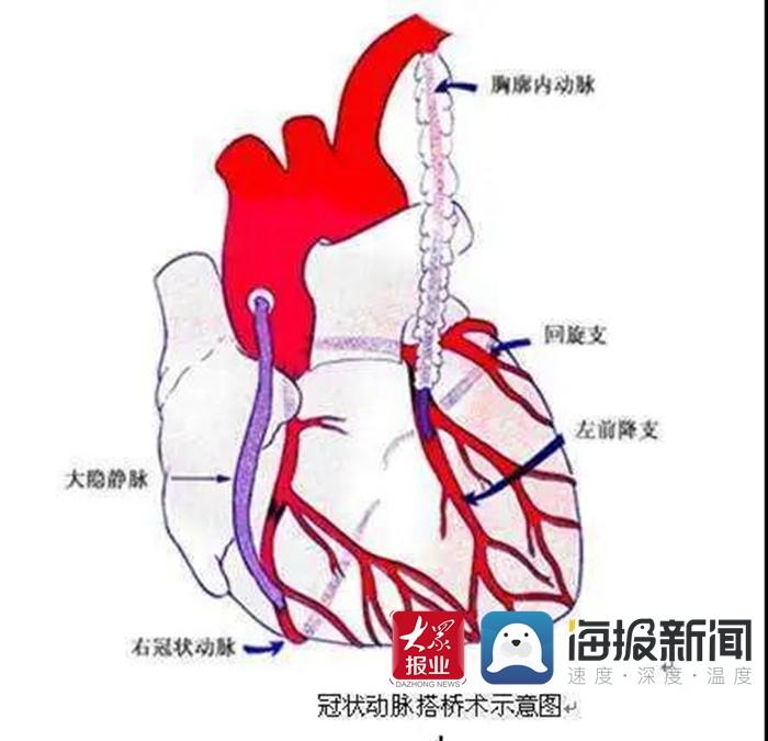 单县海吉亚医院:冠状动脉搭桥术——搭起冠心病患者生命之桥