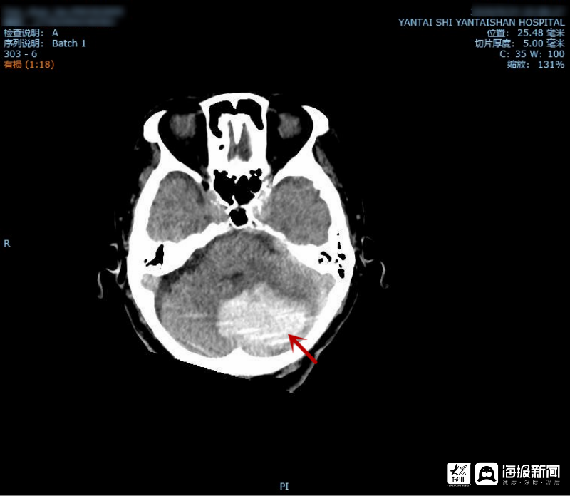烟台山医院为92岁高龄小脑出血患者手术