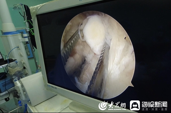 济南中医医院骨一科成功开展首例膝关节镜手术