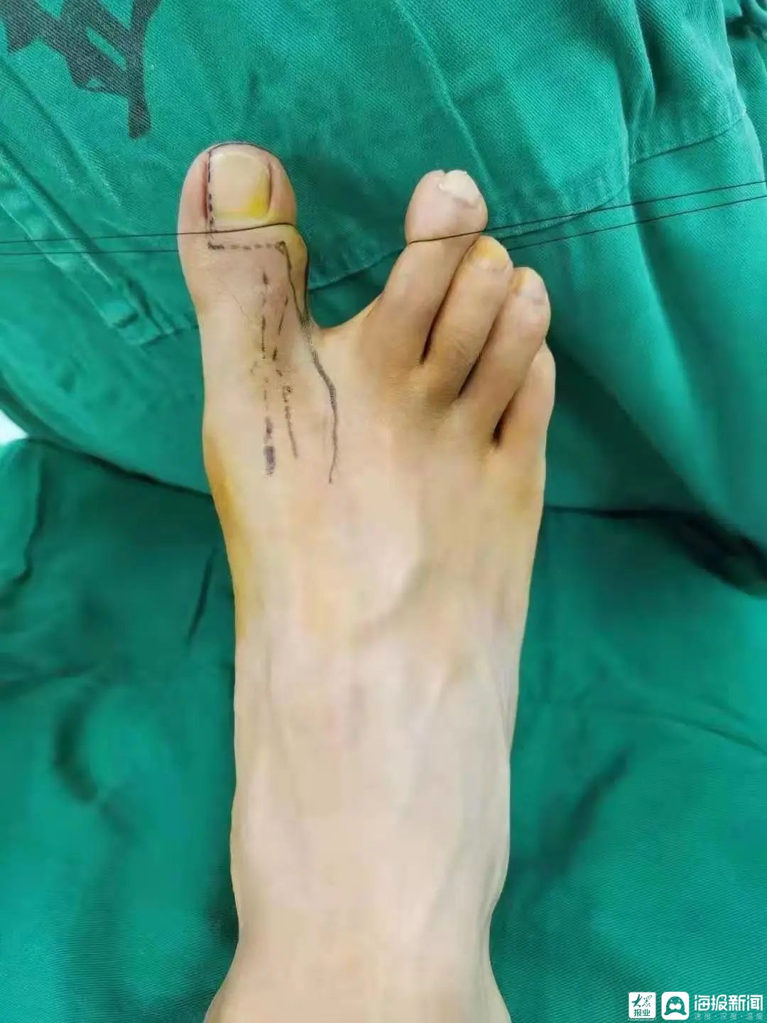 济南市第五人民医院骨科病区成功实施手拇指再造术用精湛医术帮助患者