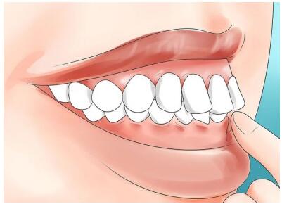 影响面部美观,同时因为下排牙齿排列过窄,限制了上排牙齿的发育,也