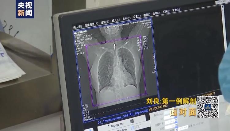 首例新冠肺炎逝者遗体解剖报告发布总台记者专访主刀医生刘良