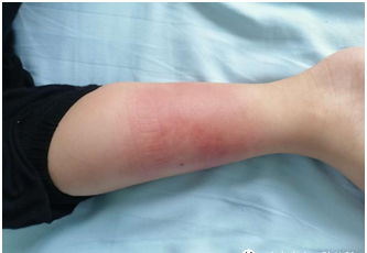 6岁孩子右腿红肿热痛影响走路,竟然是蚊虫叮咬惹的祸