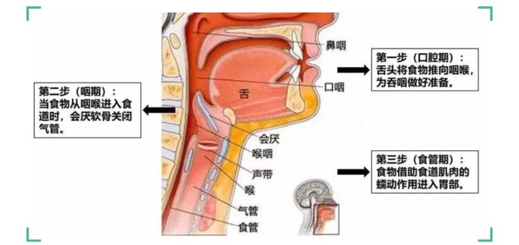 潍坊市中医院脑病康复科拔掉大象鼻让脑卒中患者重回餐桌