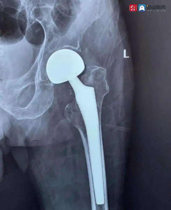 淄博圣洁医院骨科成功为八旬老人进行股骨头置换术