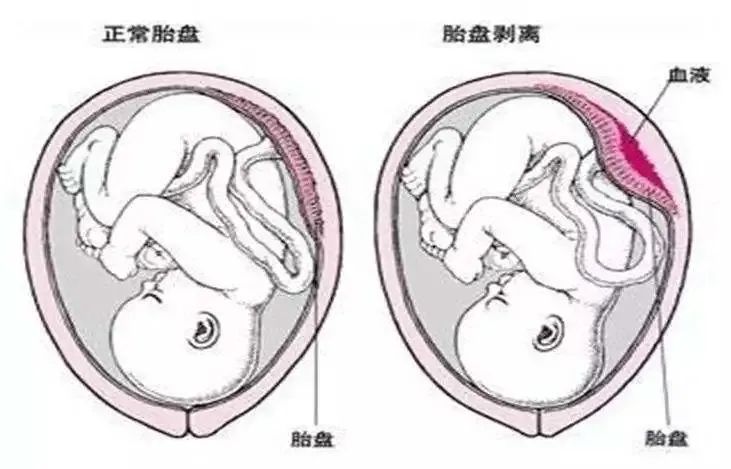 潍坊市人民医院开通绿色通道成功抢救一胎盘早剥患者