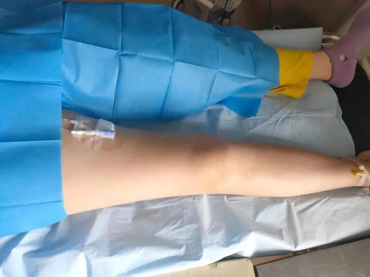 潍坊市人民医院成功完成一例经股静脉穿刺picc置管术
