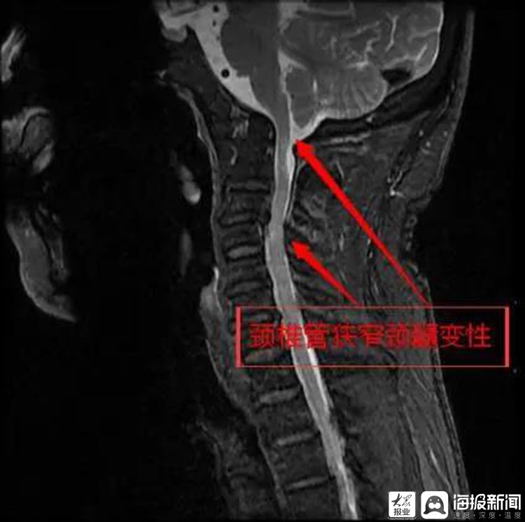 高难度枣庄市立医院成功完成一例颅底凹陷症手术治疗