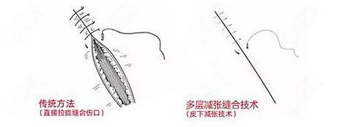 让疤痕平整如初潍坊市人民医院专家为您讲解什么是超减张精细缝合术