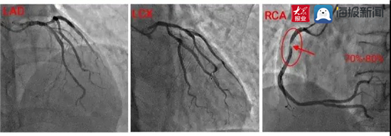 入院后行冠状动脉造影检查,冠状动脉造影结果显示心脏主要的三支血管