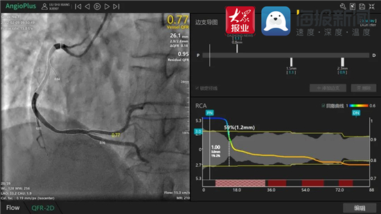 开启冠脉精准介入治疗心时代淄博市中心医院成功开展无创无耗材qfr