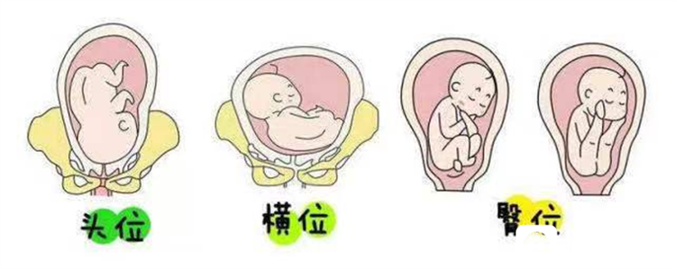 滕州市妇幼保健院成功为一例孕妇实施外倒转术