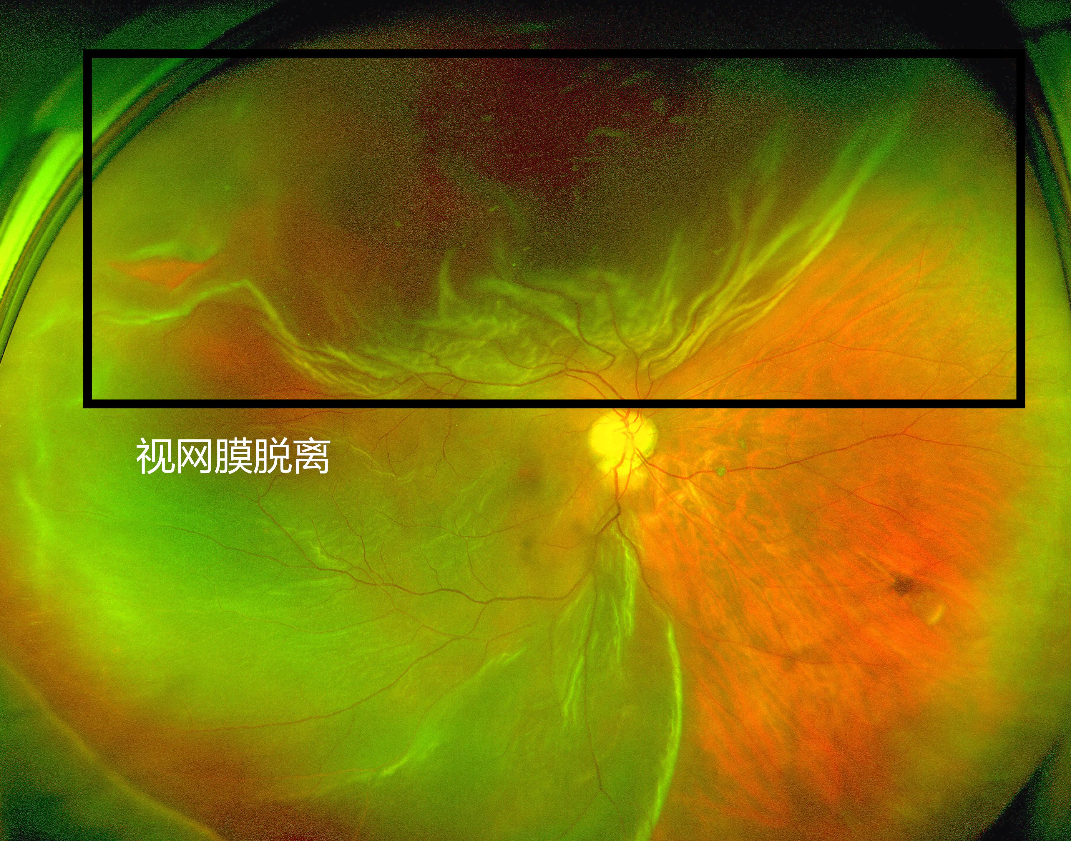 术前欧堡超广角眼底照相检查:视网膜脱离