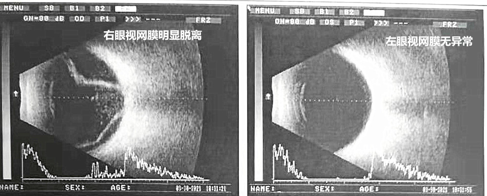 她立刻前往当地医院检查,经医生诊断陈女士为视网膜脱落,但当地的眼科