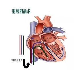 心脏射频消融术治疗心房颤动的一大利器