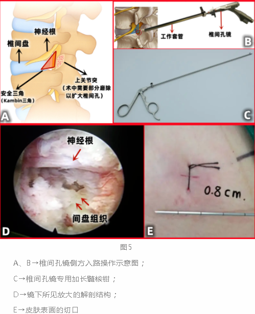 椎间孔镜宣传图片图片