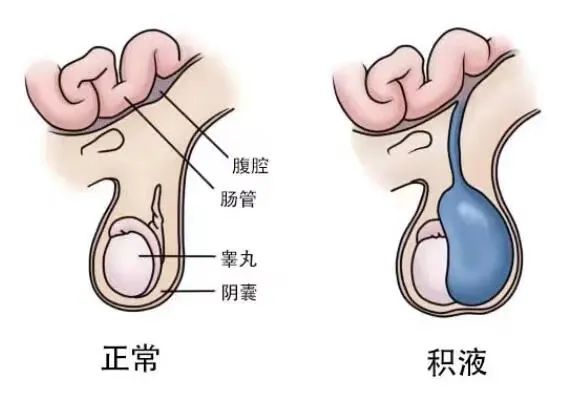 新生儿鞘膜积液图片