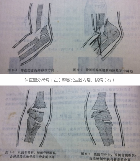 伸直型一般將肱骨髁上骨折分為伸直型與屈曲型多發年齡