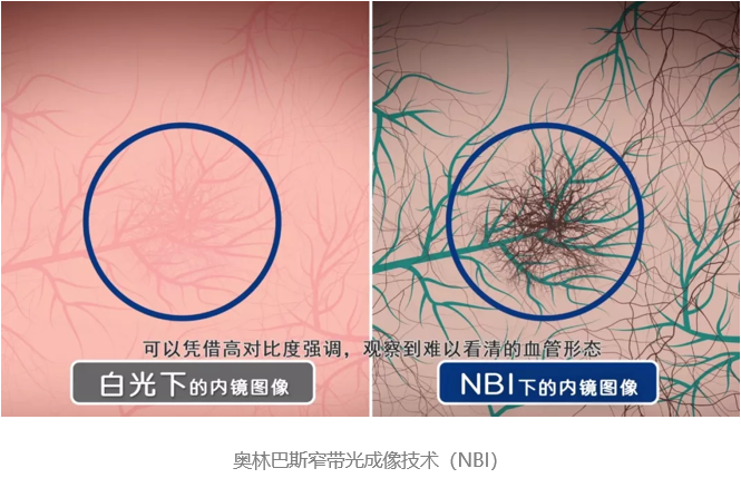 食管癌患者关爱日|“三早”伴行 畅享健康 与奥林巴斯一起远离食管癌