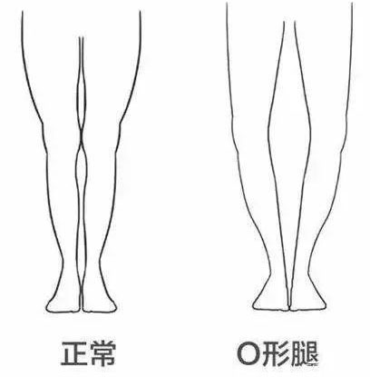 正确认识罗圈腿,及时定制矫正鞋及鞋垫干预助成长