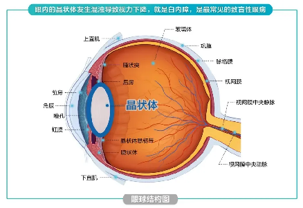 飞秒激光白内障手术的优势有哪些？北京爱尔英智眼科医院丁雪为您讲解