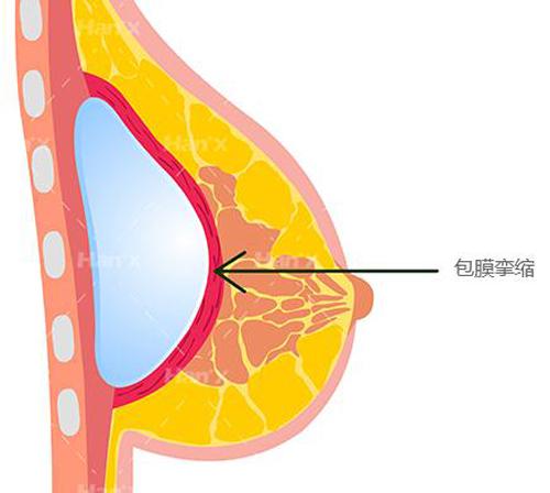 解析降低隆胸包膜挛缩几率的主要方法