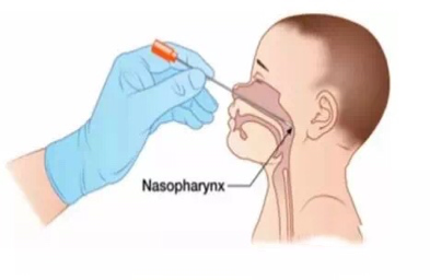 鼻咽拭子核酸示意图图片