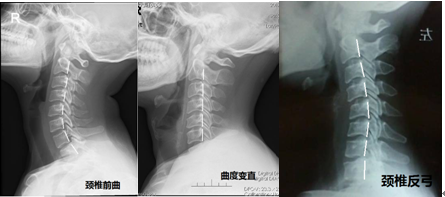 颈椎反弓侧弯图片
