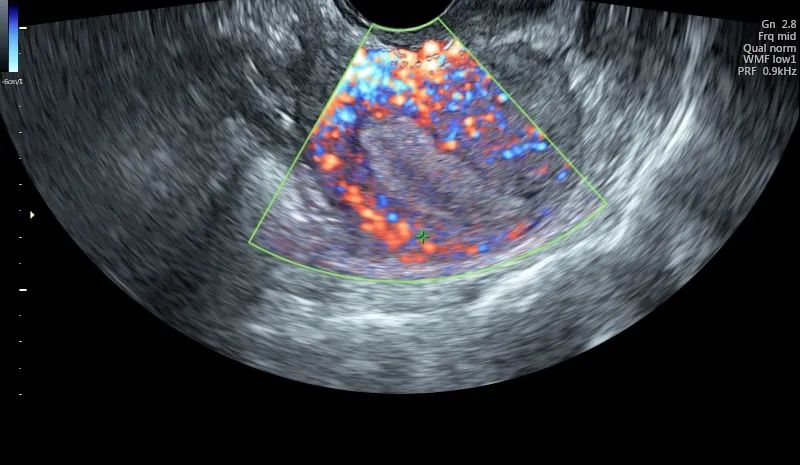 子宫内膜薄b超单图片图片