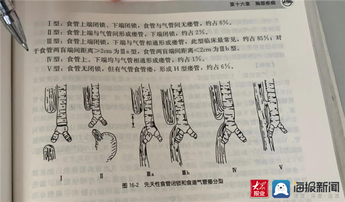 Ⅱ型:食管上端与气管间形成瘘管,下端闭锁,约2.