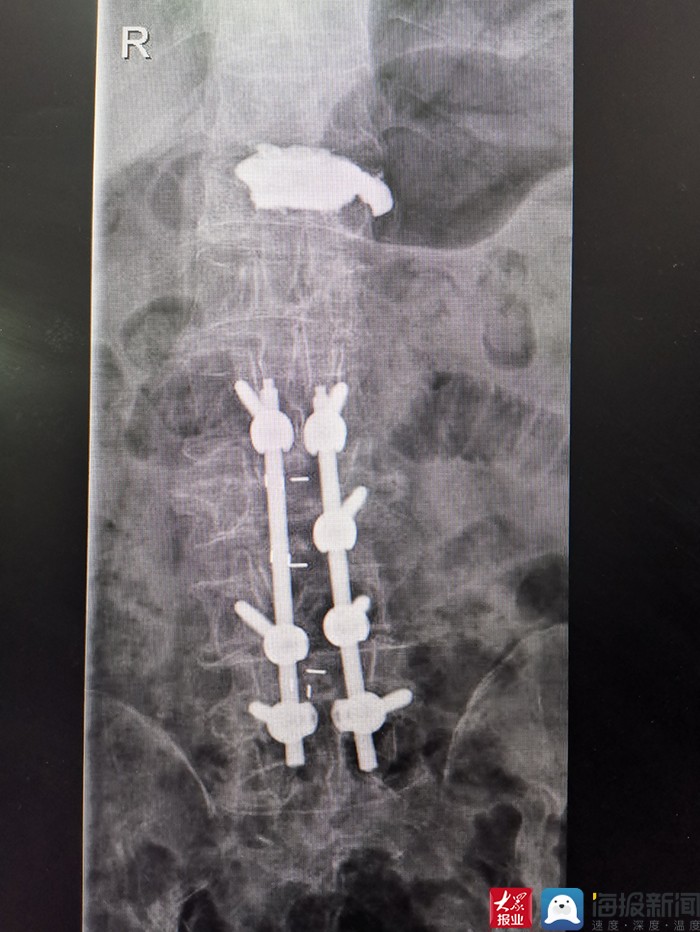 泰安市中心医院脊柱外科已成熟开展骨水泥螺钉技术