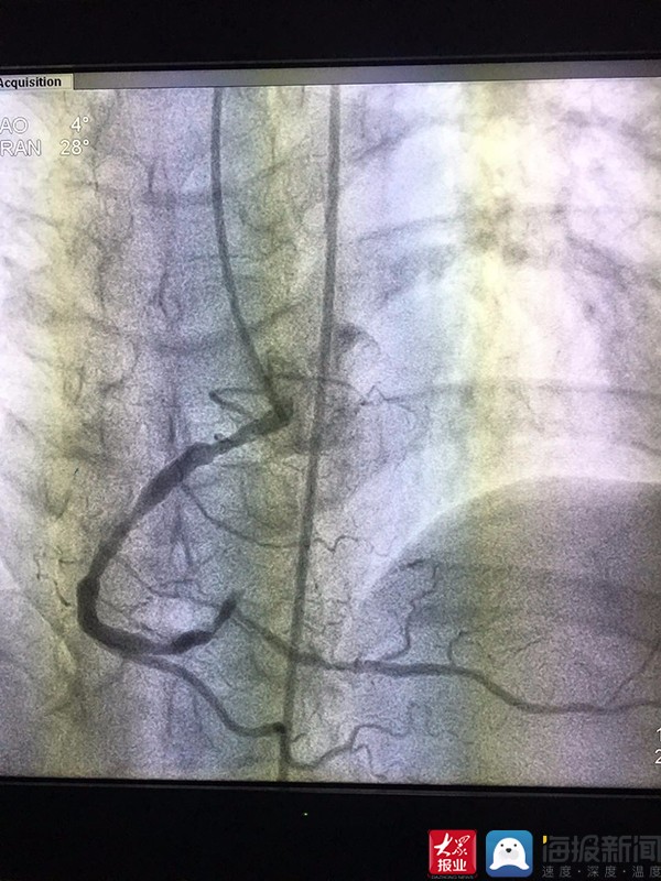 冠状动脉造影分支图图片
