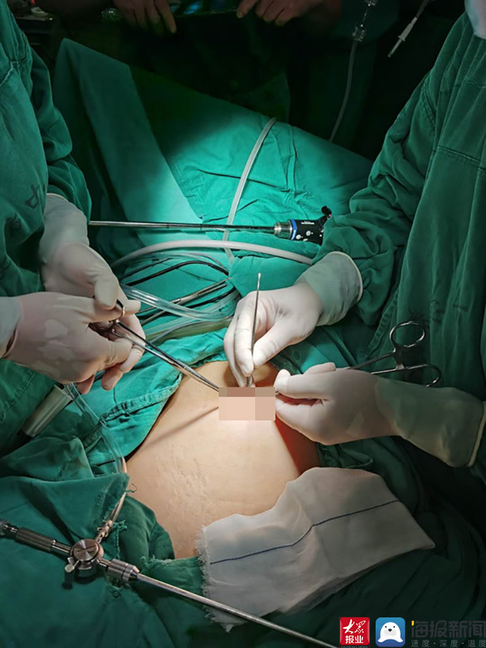 宫外孕手术微创图片