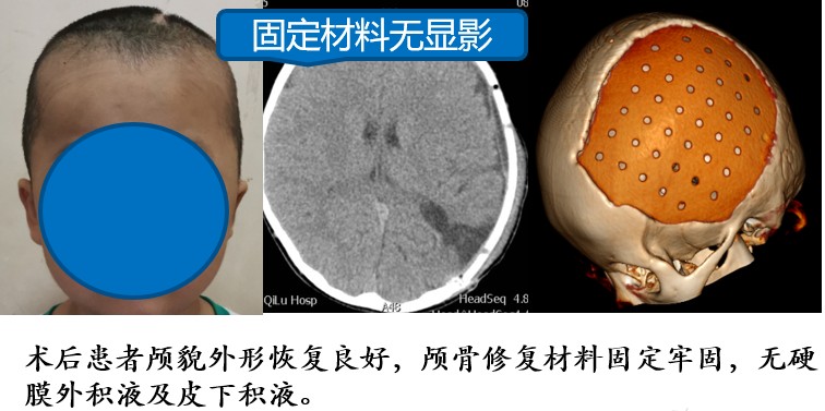 儿童颅骨骨瘤图片图片