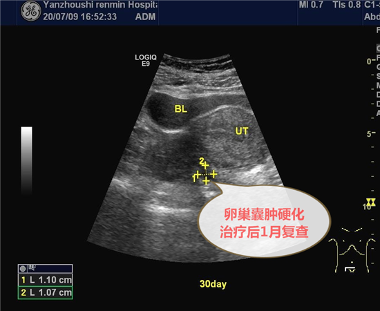 附院兖州院区超声医学科完成首例彩超引导微创硬化治疗卵巢巧克力囊肿