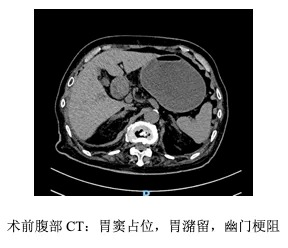 幽门梗阻ct图片