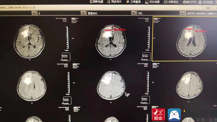 心梗症状前兆9大表现?_症状前兆表现心梗大发作_心梗的前兆反应