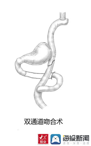 利用新手术方式 新泰市人民医院成功救治胃癌大出血病人