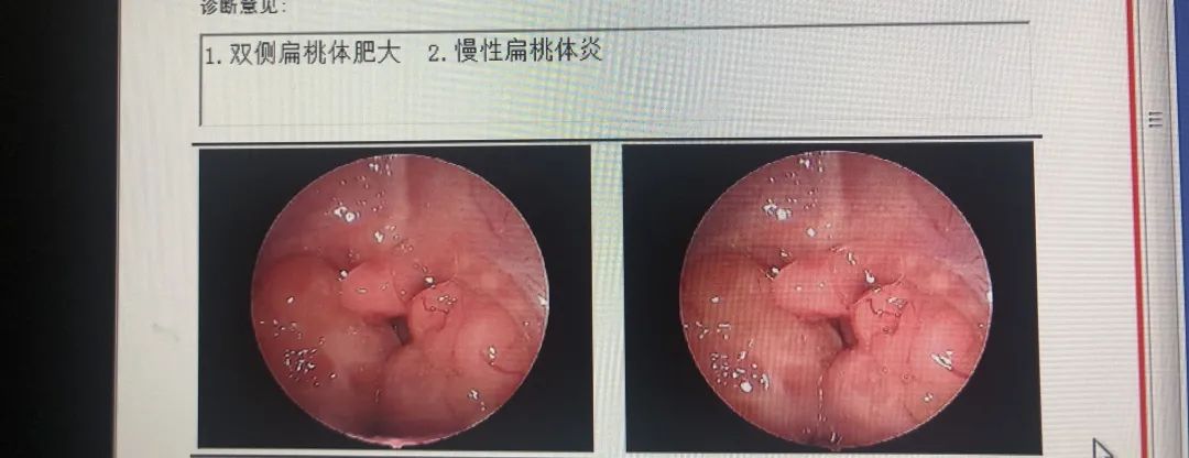 喉癌喉镜报告单图片图片