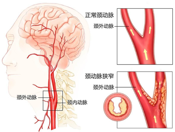 无名动脉分叉处位置图图片