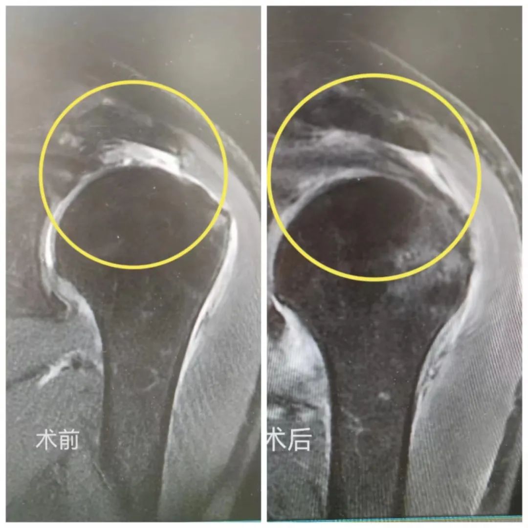 肩膀疼痛難忍濟南市第三人民醫院新技術修補嚴重撕裂的肩袖