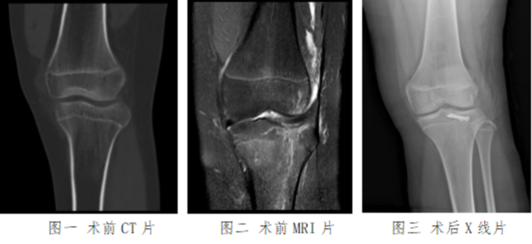 山东大学齐鲁医院（青岛）完成一例关节镜下儿童胫骨平台骨折手术