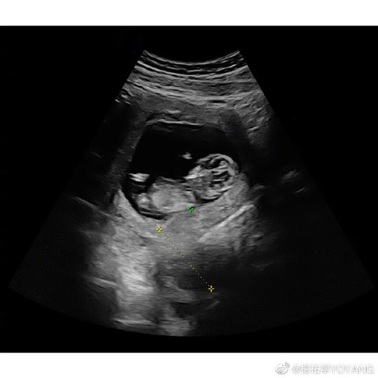 怀孕一个月b超单 真实图片
